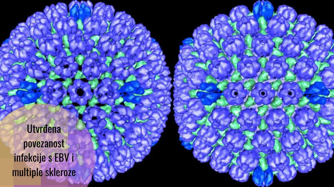 Naučnici s Harvarda: Epstein-Barrov virus povezan s multiplom sklerozom