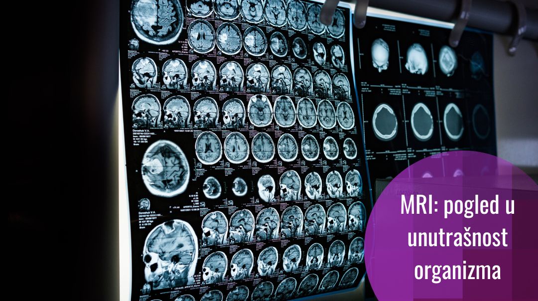 Razotkrivanje misterija organizma: kako funkcionira MRI?