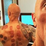 Krugovi na koži, praznine u dokazima: zašto je hidžama (cupping) više ritual nego medicina