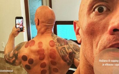 Krugovi na koži, praznine u dokazima: zašto je hidžama (cupping) više ritual nego medicina