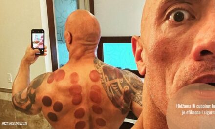 Krugovi na koži, praznine u dokazima: zašto je hidžama (cupping) više ritual nego medicina