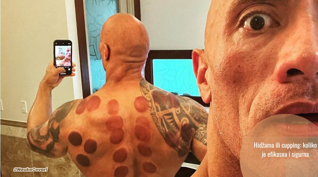 Krugovi na koži, praznine u dokazima: zašto je hidžama (cupping) više ritual nego medicina